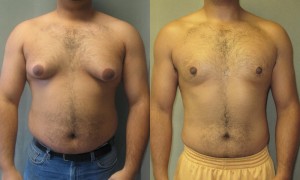 Gynecomastia causes enlarged breasts in men. Photo: Wikimedia Commons 